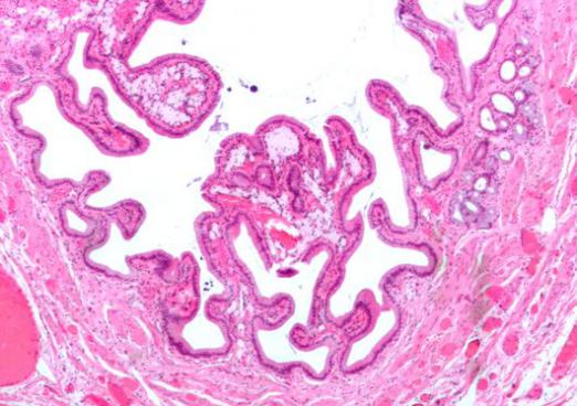 Cholecystitis: hva er det?